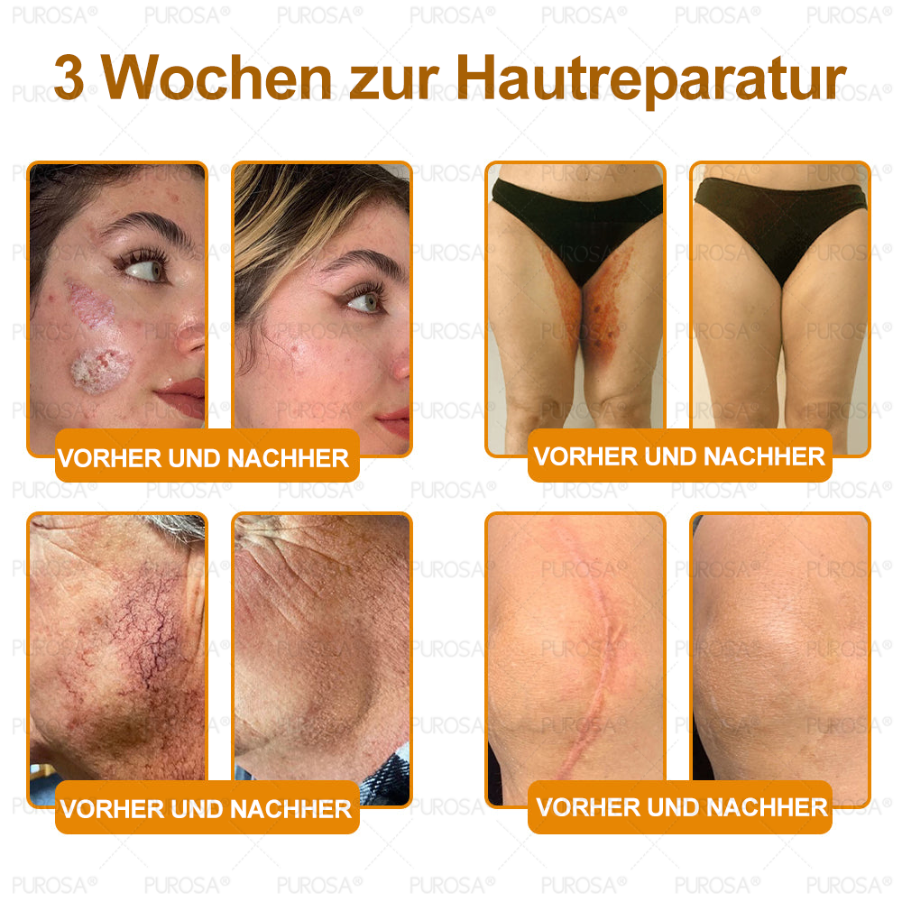❤️𝗣𝗨𝗥𝗢𝗦𝗔® 8-in-1 Bienengift & Talg Hautcreme – Jetzt -80% · Sichtbare Wirkung in 7 Tagen · Nur heute letzter Tag!