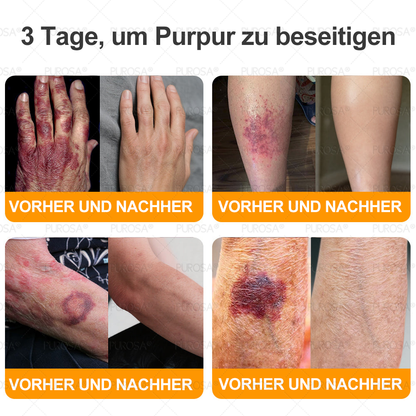 ❤️𝗣𝗨𝗥𝗢𝗦𝗔® 8-in-1 Bienengift & Talg Hautcreme – Jetzt -80% · Sichtbare Wirkung in 7 Tagen · Nur heute letzter Tag!